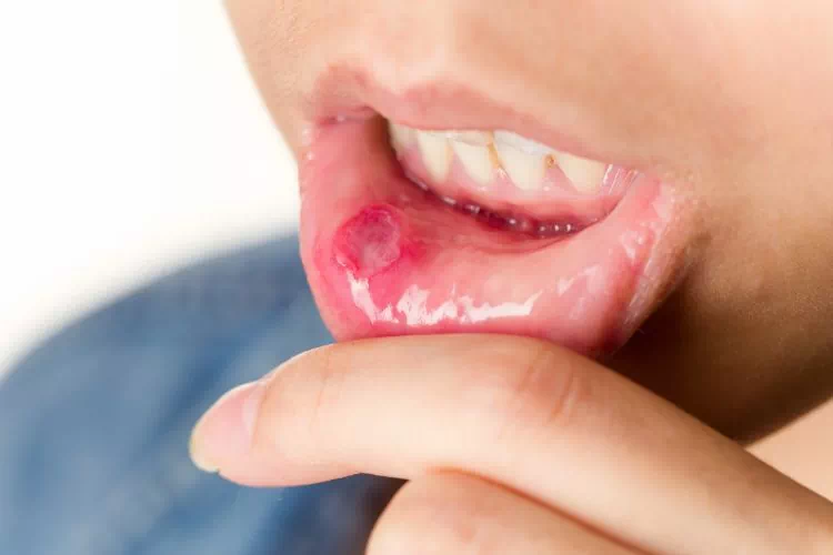 Aphte dans la bouche