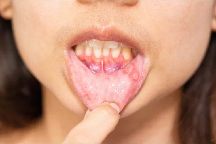 Aphte dans la bouche